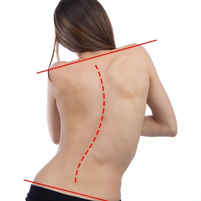 https://coreposturechiropractic.com/wp-content/uploads/2019/05/newport-beach-scoliosis-treatment.jpg