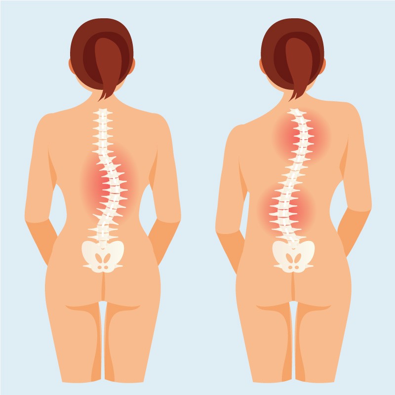 C-Shape Scoliosis and S-Shape Scoliosis