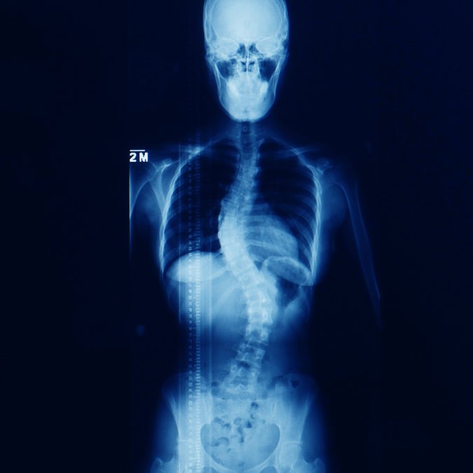 Newport Beach Scoliosis Chiropractor