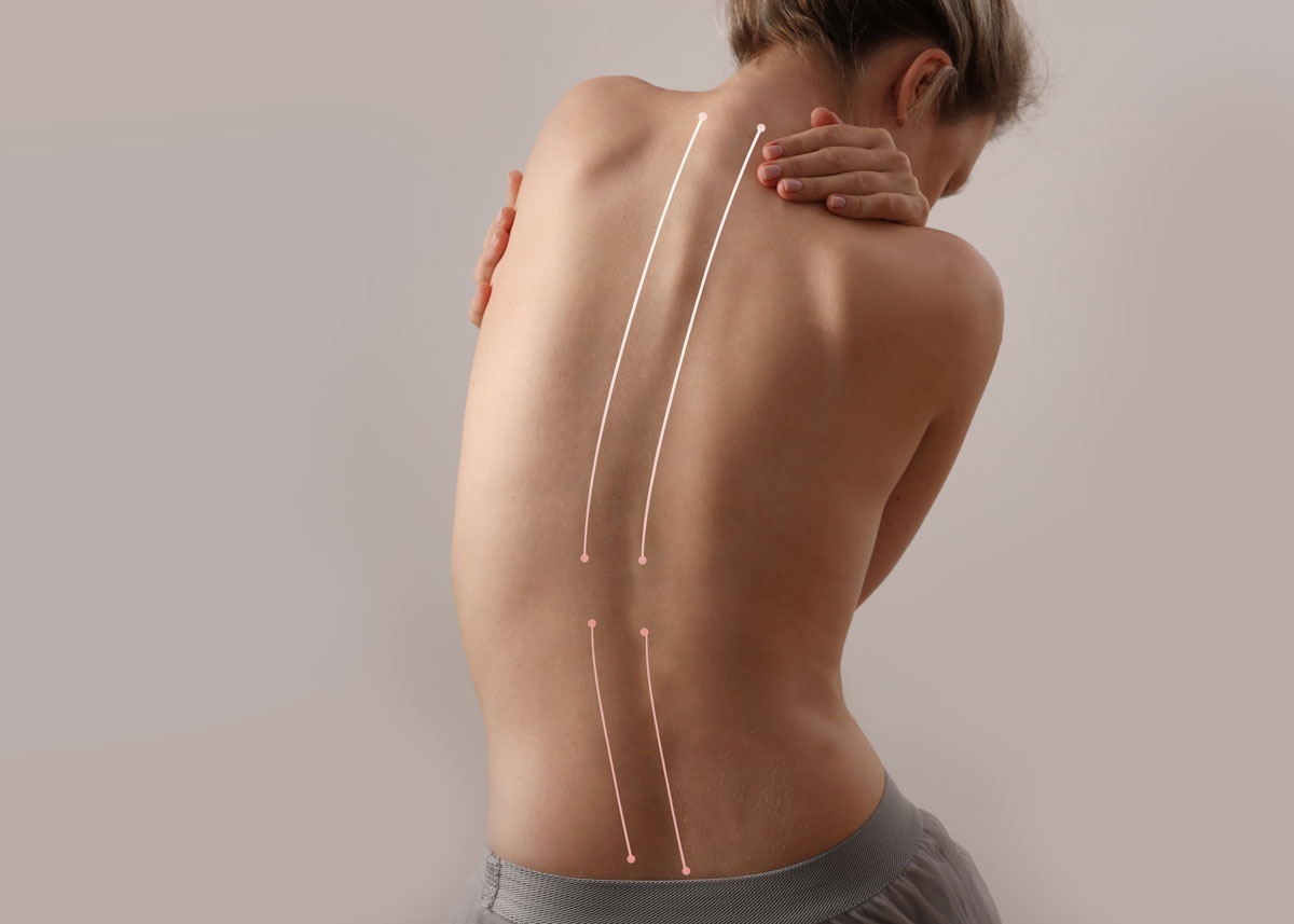 Patient with Severe Scoliosis Getting Treatment at CorePosture in Newport Beach CA