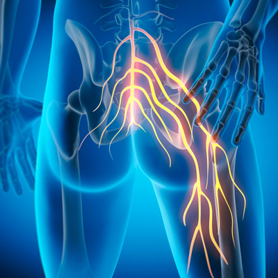 Can a chiropractor help sciatica