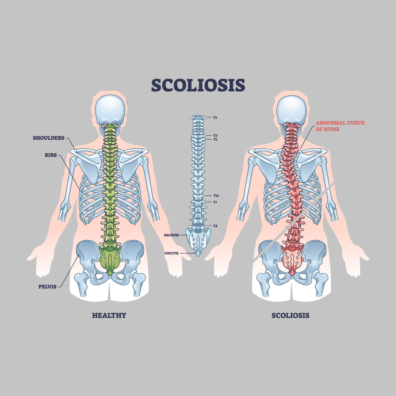 Normal spine versus scoliosis curve spine - Core Posture Chiropractic in Newport Beach CA