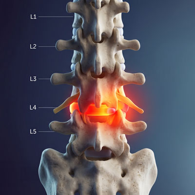 L4-L5 Herniated Disc
