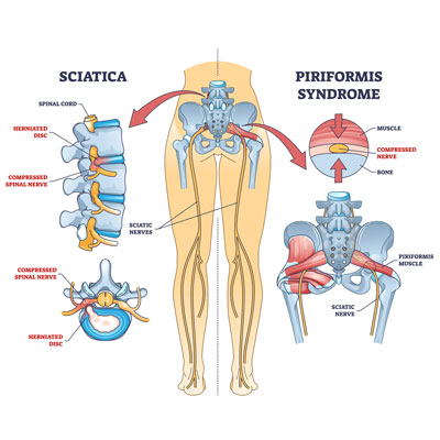 Sciatica vs Piriformis Syndrome